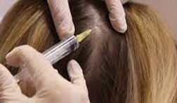 Mesotherapy FOR HAIR